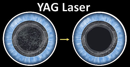 YAG Capsulotomy (laser for an "after cataract")